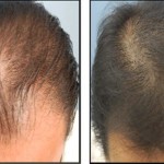 Мезотерапия для волос фото до и после